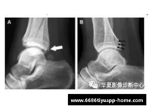 球员踝骨骨折：原因、治疗及康复全解析